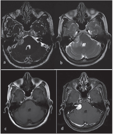 Figure 3: Schwannoma presented with hearing loss, tinnitus, and headache. (a) Constructive interference in steady-state axial image and (b) T2-weighted imaging showing right-sided intracanicular and cerebellopontine angle tumor compressing the pons. (c) It is hypointense on T1-weighted imaging and showing (d) intense homogeneous enhancement of the tumor. The tumor is encasing the VII and VIII nerves. (Source: P. Yodev et al., 'Magnetic resonance imaging of cerebellopontine angle lesions', Medical Journal of Dr. D.Y. Patil University, Wolters Kluwer, 2015, Vol. 8, Nr. 6, p. 751-759)