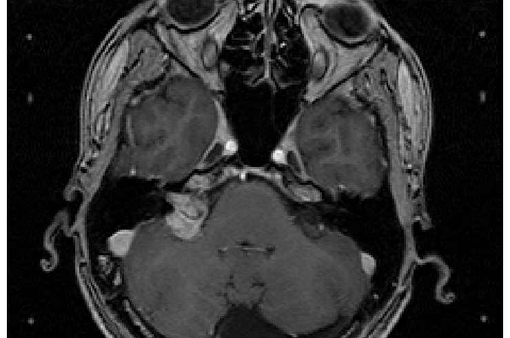 Outcome predictors for Gamma Knife radiosurgery on brain tumors (vestibular schwannoma)